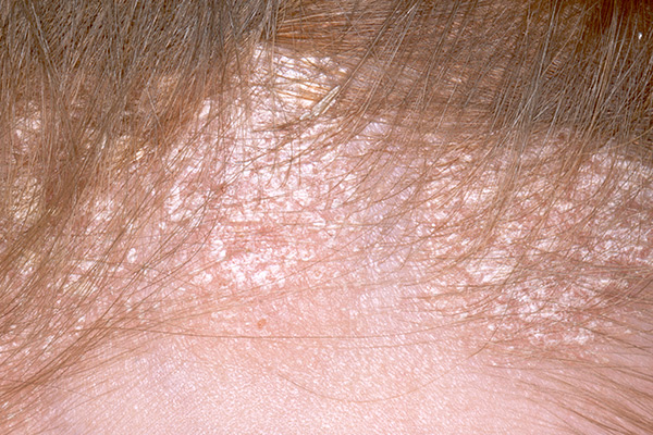 What Are the Causes of The Scalp Itching Problems