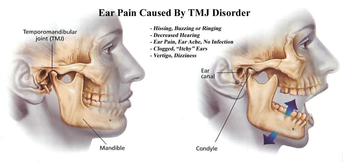 What is Temporomandibular Disorder?