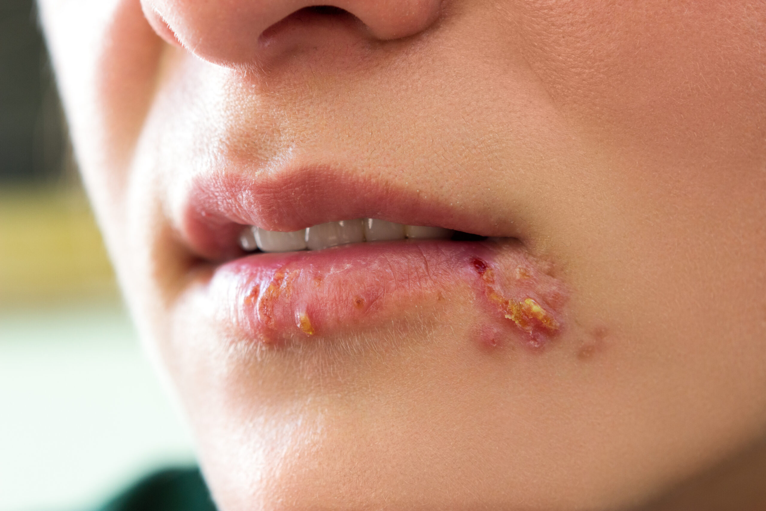 4 Things You Should Know About Herpes And Its Prevention