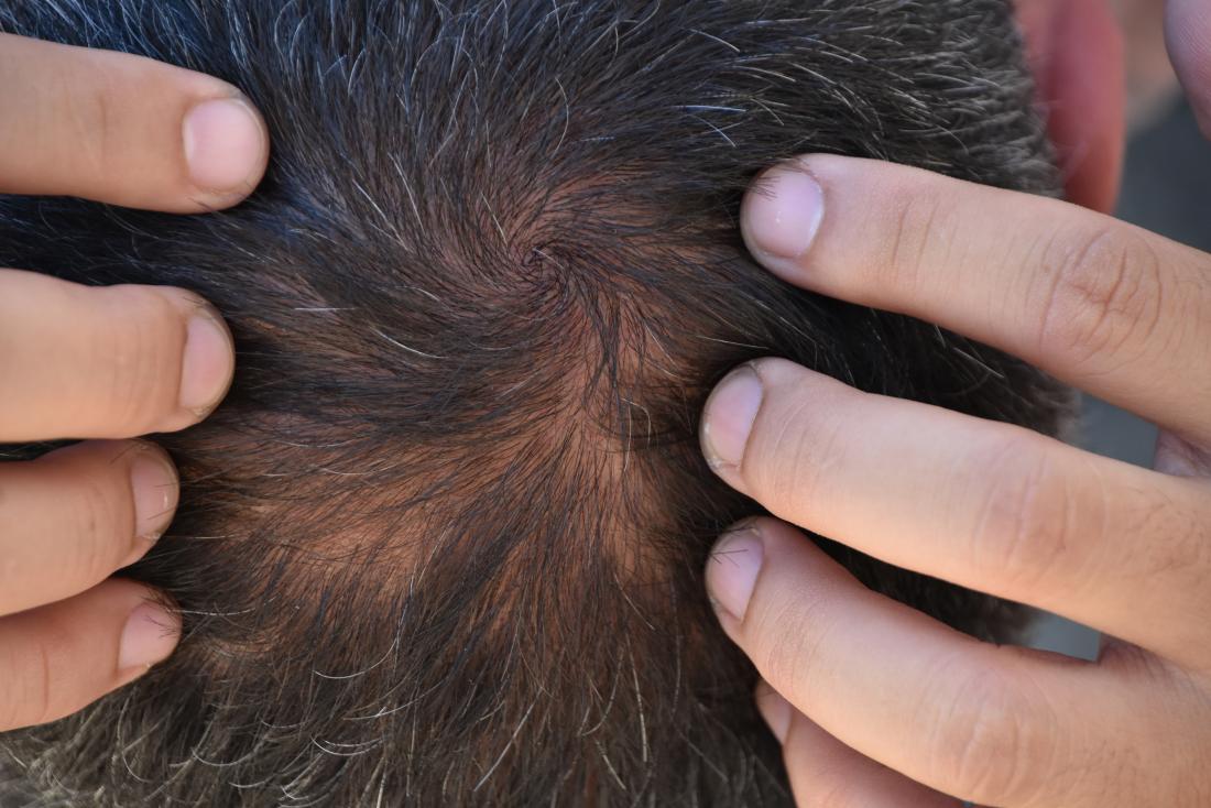 Minoxidil and Hair Loss: Is It Right for You?