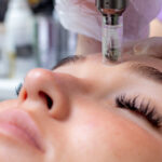 Microneedle Therapy: Unlocking Skin Rejuvenation with Precision