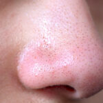 Managing Sebaceous Filaments and Open Pores Effectively