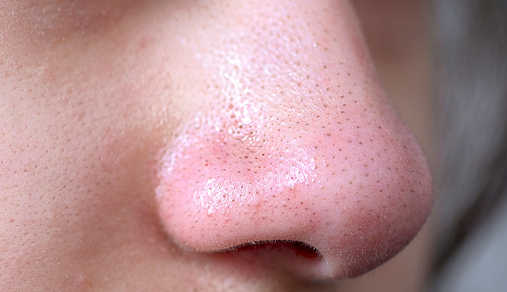 Managing Sebaceous Filaments and Open Pores Effectively